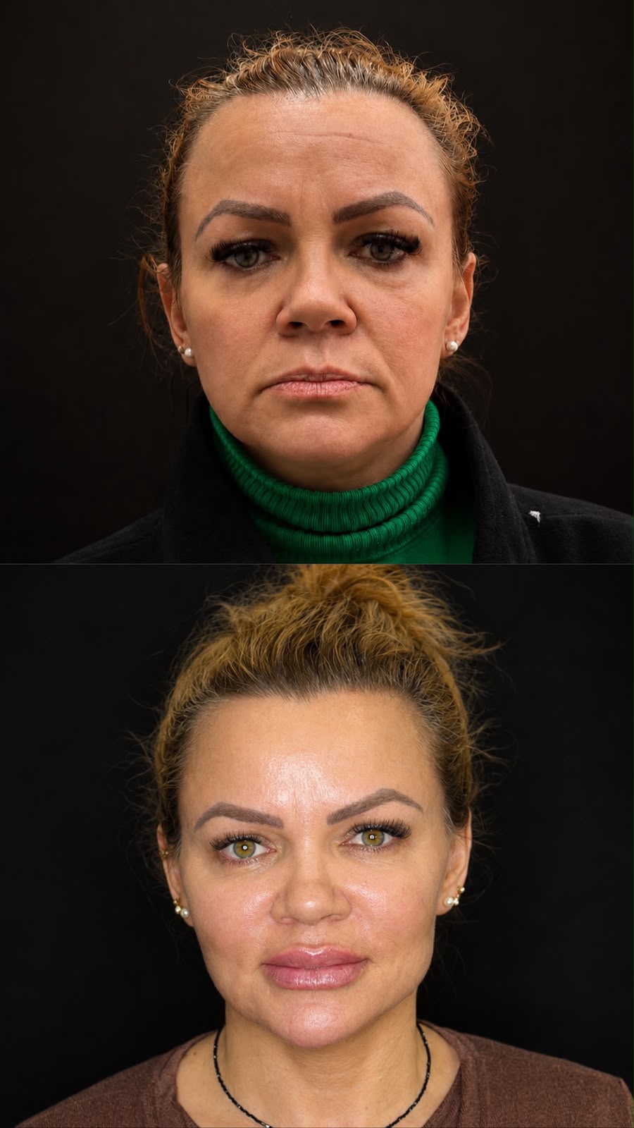 Harmonização Facial na Virtuosa Porto Alegre Zona Norte