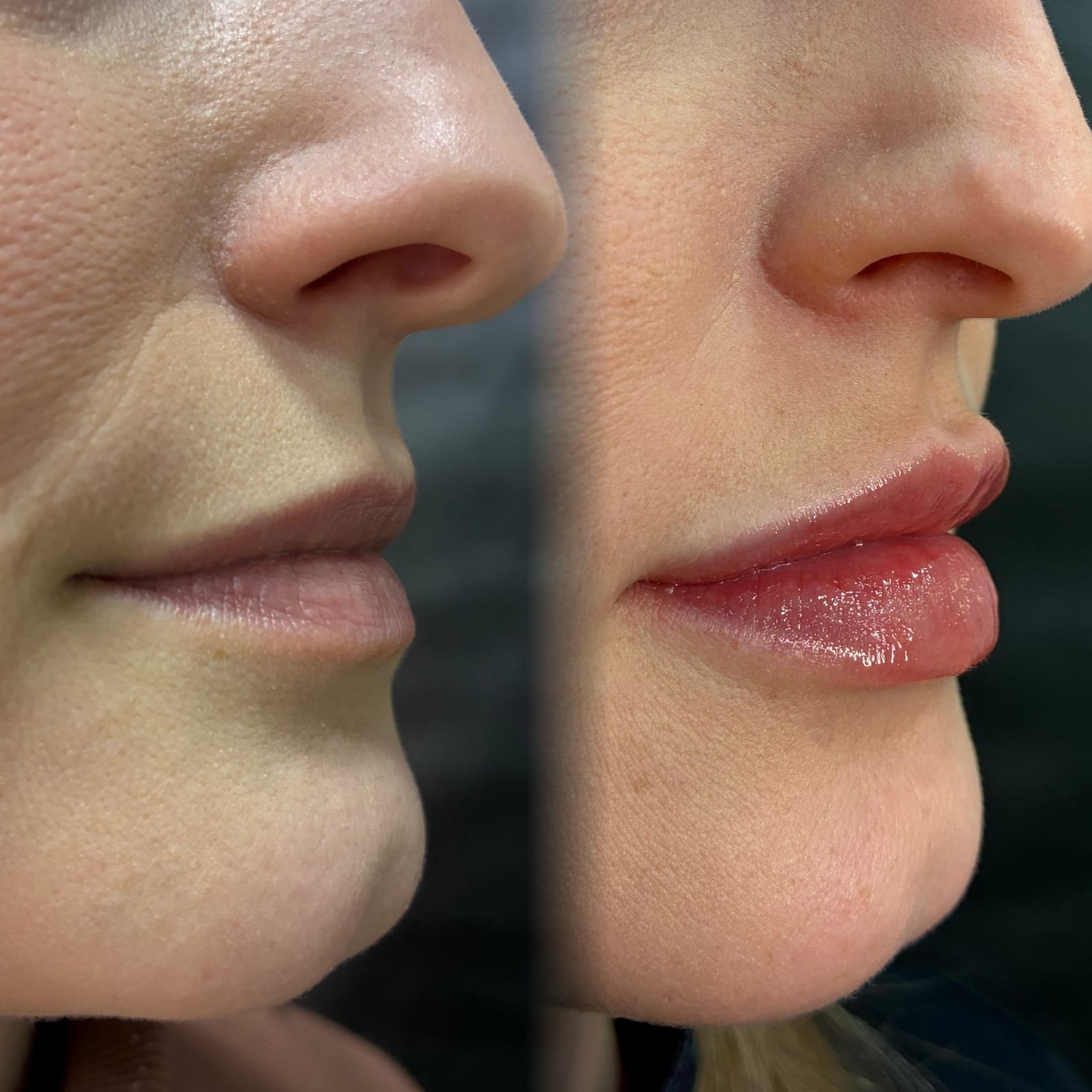 Preenchimento Labial na Virtuosa Porto Alegre Zona Norte